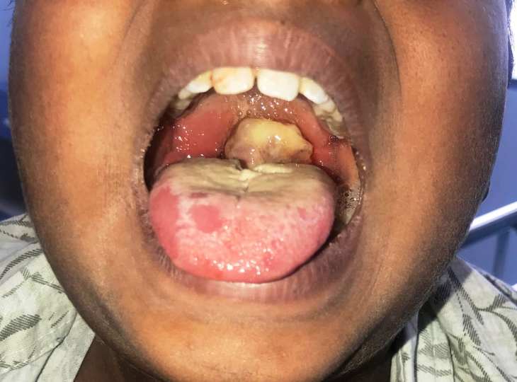 An outbreak of suspected diphtheria disease has claimed three lives in Zaria, Kaduna State, with six others infected. 