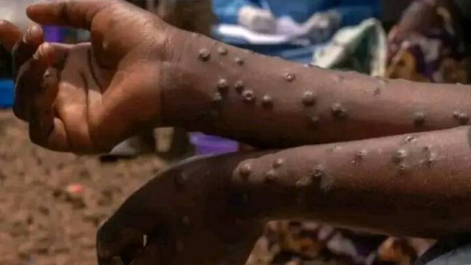 Mpox spreads across five Benue LGAs with 31 confirmed cases